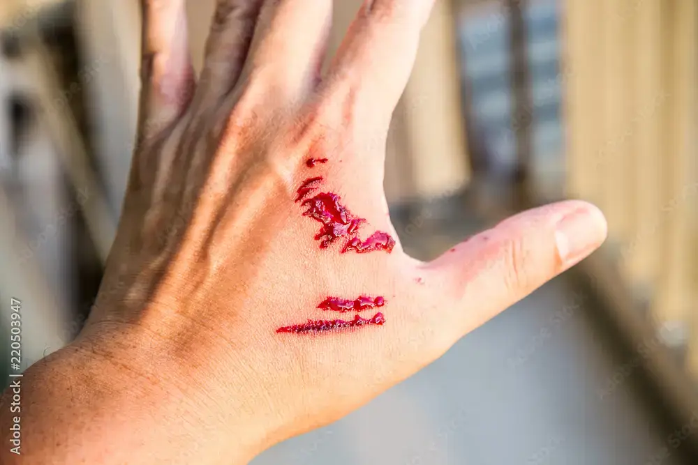 Atlanta Dog Bite Lawyer - Coker Accident Lawyers